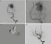 Abb. 2a-d: Embolisationstechniken