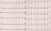 Abb. 4: EKG