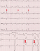 Aktuelles Bild - Abb. 1: Ventricular premature beats
