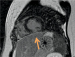 Abb. 5: Late-Enhancement