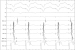 Abb. 4: EKG