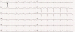 Abb. 10: EKG