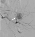 Aktuelles Bild - Abb. 3: Blutungsspeisende Arterie