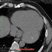 Abb. 6: CT-Thorax