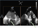 Aktuelles Bild - Abb. 4a-b: MitraClip-Implantation