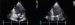 Abb. 7: Restinsuffizienz (Entlassung)