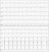 Abb. 1: Aufnahme-EKG