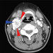 Abb. 2: CT der Halsweichteile