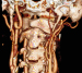 Aktuelles Bild - Abb. 1: CTA with 3D reconstruction