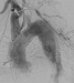 Abb. 2: Produkt: Stentgraft<br>
Vertrieb: Jotec GmbH
