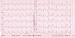 Abb. 1: EKG