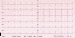 Aktuelles Bild - Abb. 2: EKG