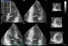 Abb. 3: LV-Volumina - LV-EF