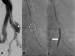 Abb. 2A-C: Produkt: E-liac Stentgraft<br>Vertrieb: JOTEC GmbH