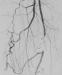 Abb. 1: A. femoralis superficialis - A. profunda femoris