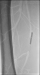 Aktuelles Bild - Abb. 2: A. femoralis superficialis