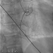 Aktuelles Bild - Abb. 1: Herzkatheter