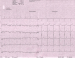 Abb. 1: EKG