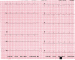 Abb. 1: EKG