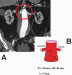 Abb. 4: Infrarenales Aortenaneurysma