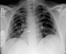 Aktuelles Bild - Abb. 2: Chest x-Ray