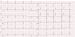 Aktuelles Bild - Abb. 1: EKG