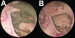 Abb. 5A-B: Foramen Monroi