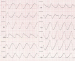 Abb. 1: EKG
