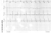 Aktuelles Bild - Abb. 3: Intrakardiales EKG