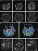 Abb. 2: Status epilepticus