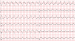 Abb. 2: EKG
