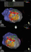 Aktuelles Bild - Abb. 3: Diatolischer Pfad - Kritischer Isthmus