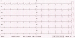 Abb. 3: EKG nach Intervention