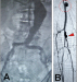 Abb. 2A-B: Aneurysmen