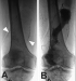 Abb. 6A-B: PAA bei Arteriomegalie
