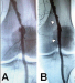 Aktuelles Bild - Abb. 10A-B: Endovaskulre Therapie
