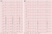 Abb. 4: AAI-Stimulation