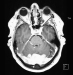 Abb. 1: Okzipitale Tumormasse