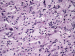Abb. 3: Tumor