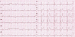 Aktuelles Bild - Abb. 1: EKG