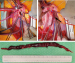 Abb. 2: Clot-In-Transit