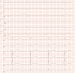Abb. 1: EKG