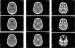 Abb. 3: Computertomographie  Rezidiv