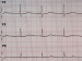 Abb. 3: EKG