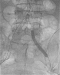 Abb. 3: IVL-Therapie