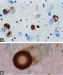 Abb. 1a-b: Lewy-Pathologie