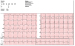 Abb. 1: EKG