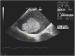 Aktuelles Bild - Abb. 2: Gestielter Vorhofthrombus