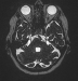 Aktuelles Bild - Abb. 1: Trigeminusneuralgie