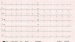 Abb. 5: EKG